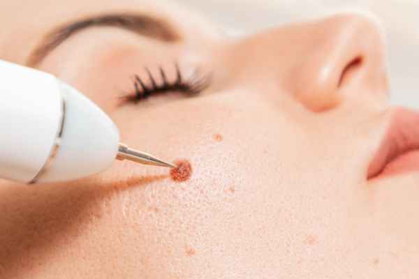CryoPen: 5 Skin Concerns It May Be Used to Treat 3 What actually happens during a CryoPen treatment Kilmarnock?