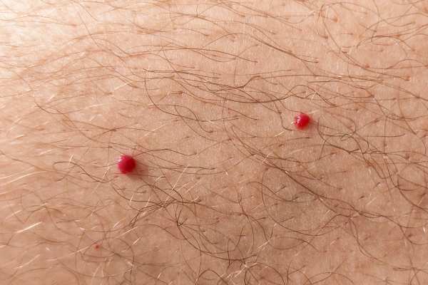 CryoPen: 5 Skin Concerns It May Be Used to Treat 2 cherry angioma removal Kilmarnock