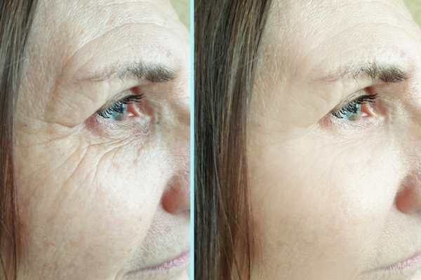 Why Do People Choose HIFU for a Non-Surgical Facelift? 4 How long can HIFU results last Kilmarnock?