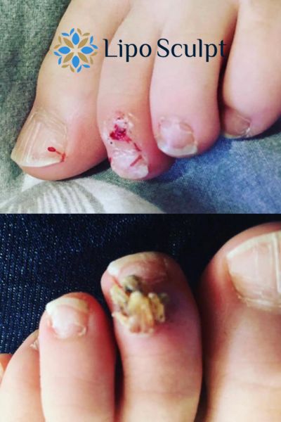 Wart removal customer results from Lipo Sculpt Kilmarnock